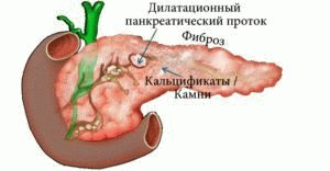 Chronische pancreatitis