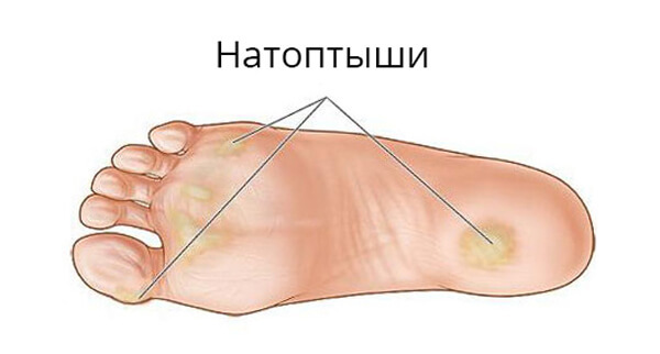 Pain-joints-big-toe-toes