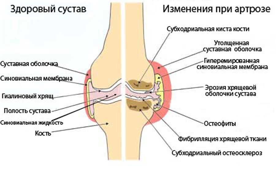 artroze-zglobovi