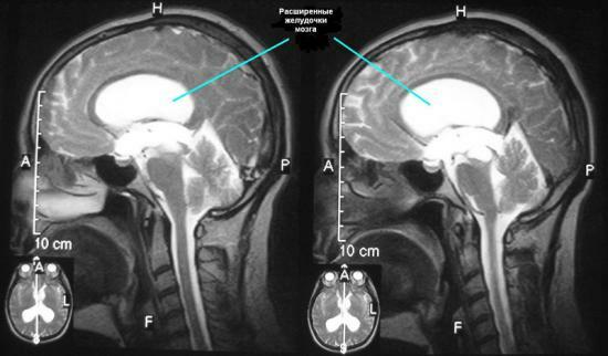 External replacement hydrocephalus of the brain