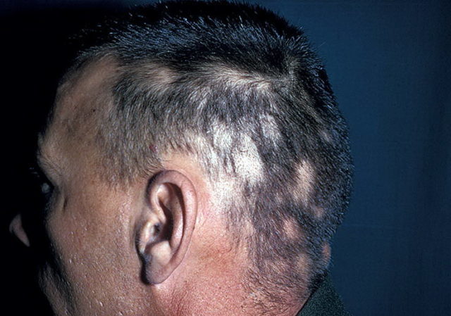 Hvorfor taber mænd hår på hovedet?