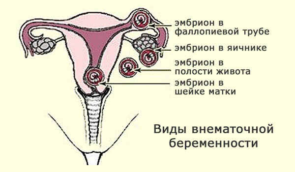 הריון חוץ רחמי