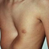 Orthopädie der Brust bei Kindern