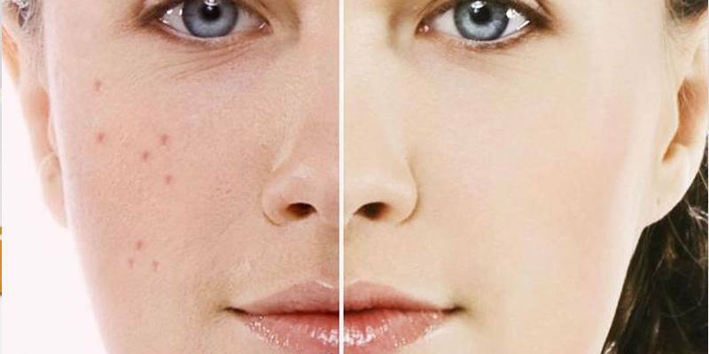 Ansigt før og efter påføring af kapsler fra acne