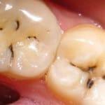 Geschwollenes Zahnfleisch um den Zahn