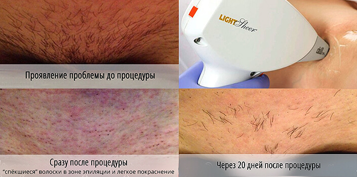 Photoepilation and laser hair removal: what is better