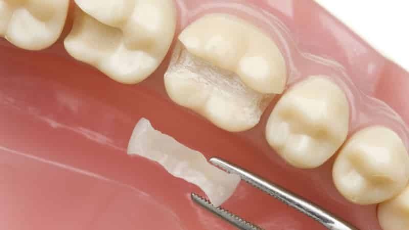 Tipos de próteses dentárias: os prós e contras de técnicas e tecnologias modernas