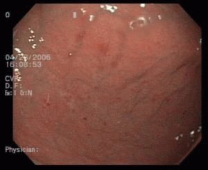 Ontstoken maagwand