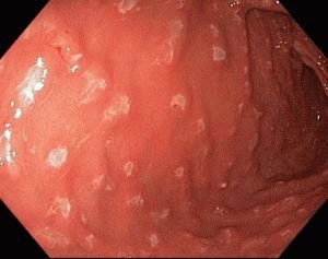 Erosieve gastritis