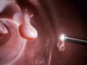 Ziede Hepatrombīns G: atsauksmes par hemoroīdiem un lietošanas instrukcijas