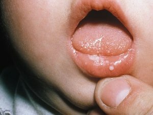 ילדים stomatitis