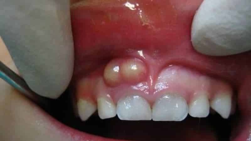Fluss mit der Entzündung des Zahnfleischs an einem Tag entfernen