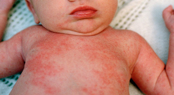 Allergi mot babypulvermedel