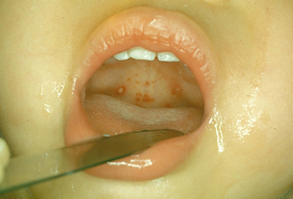 Symptoms of herpetic sore throat in children