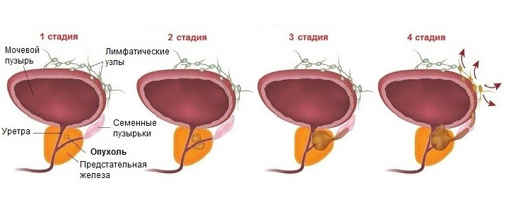 Stages of prostate cancer