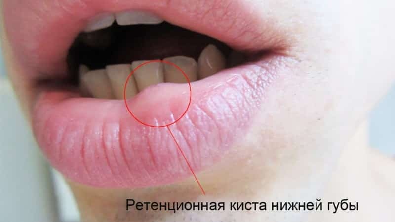 zadrževanje cista na spodnji fotografiji ustnice
