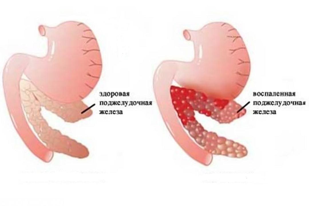 Um pâncreas dilatado: causas e tratamento, dieta