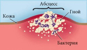 Abcessos no corpo