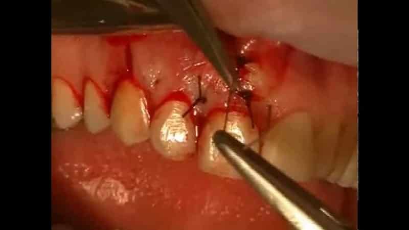Radectomy: was es ist und bei der Anwendung