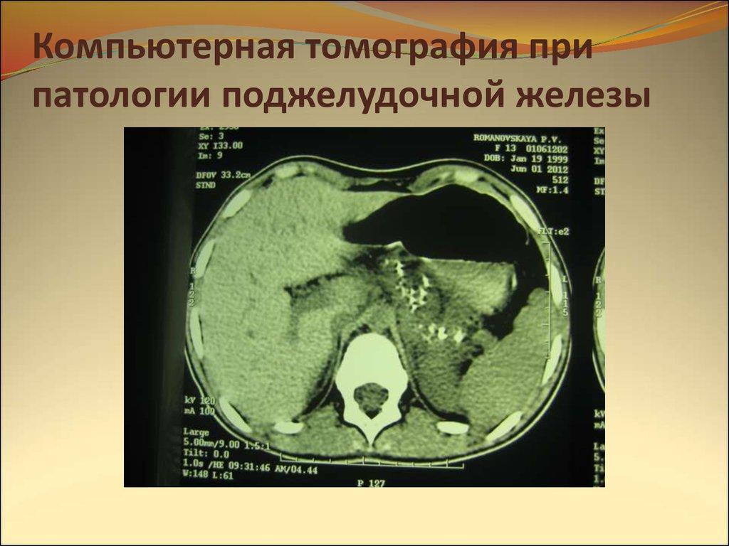 Tomografia computadorizada do corpo ao nível do pâncreas