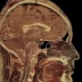 Pituitary adenomas: clinical picture, diagnosis, treatment
