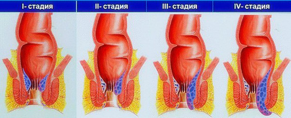 Internal hemorrhoids: symptoms and treatment
