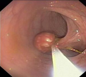 Polyposis van de sigmoïde colon