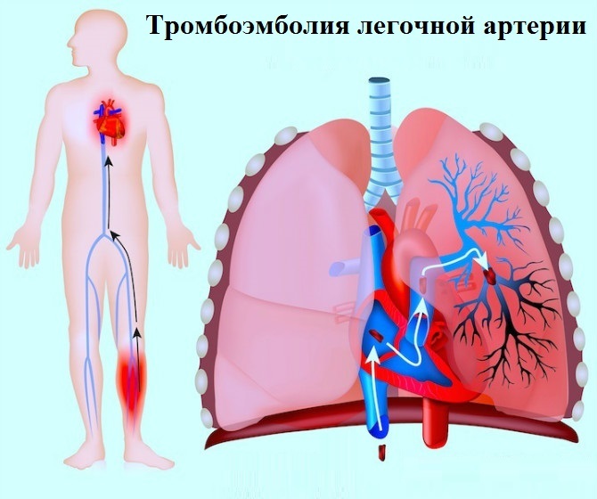 tromboembolija, plućna arterija-