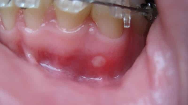 Stomatitis zu Zahnfleischbehandlung