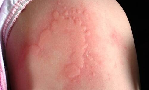 Fotografija hladnoće alergije