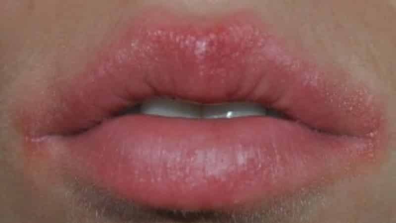 bolhas brancas nos lábios