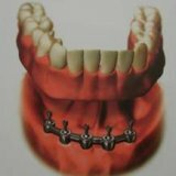 Implantatie bij afwezigheid van tanden