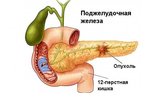tumor gušterače žlijezde