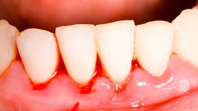 Blødende tandkød i barnets: hvad man skal gøre i 2 år