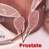 Symptomer på prostatakreft