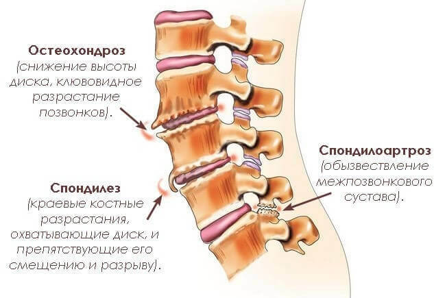 Spondylóza bedrovej-sakrálnej chrbtice