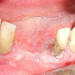 Geschwollenes Zahnfleisch als auszuspülen