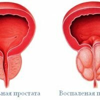 Fytotherapie bij de behandeling van prostatitis