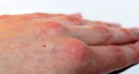 Die Symptome der Pickel auf den Händen