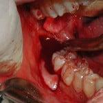 Verwijdering van de onderste tand-achten