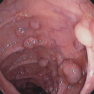 Intestinale polyposis