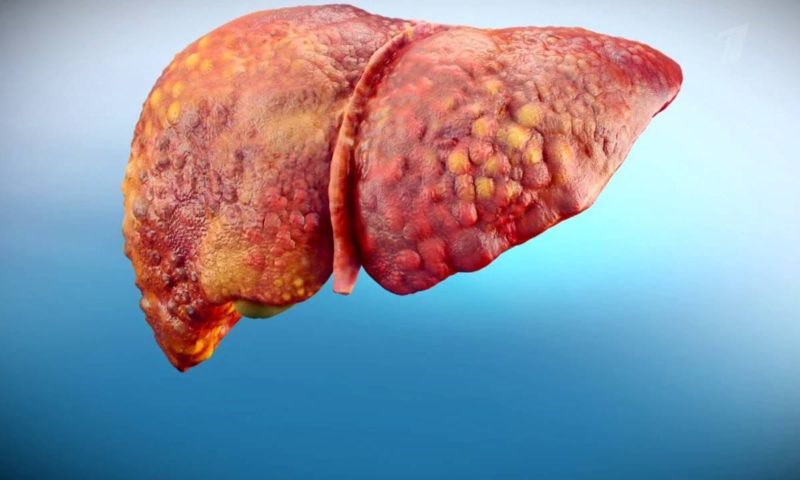 Leverfibrose 1, 2, 3 en 4 graden: wat is het, hoe te behandelen, symptomen