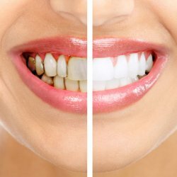 Kako spriječiti nastanak zubnih plakova?