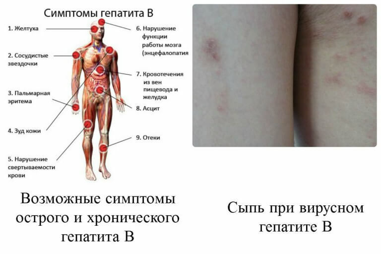 Hepatitis B: simptoma, način infekcije, liječenje