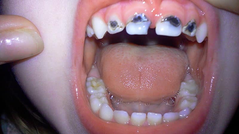 Очень плохие зубы фото