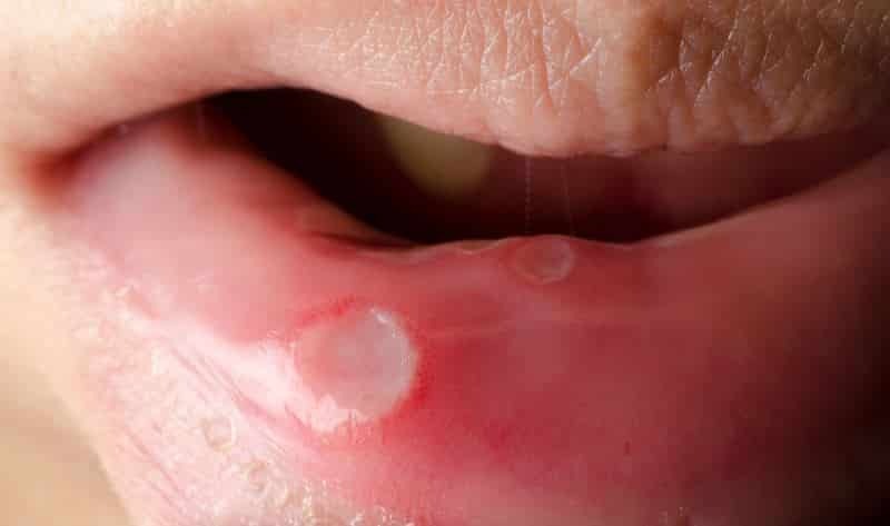 Wrzodziejące zapalenie jamy ustnej zdjęcia
