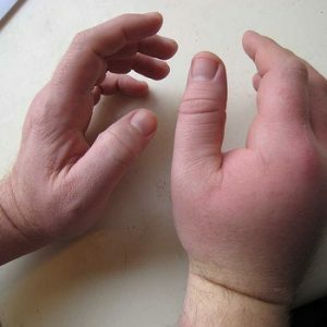 Swelling of the hands