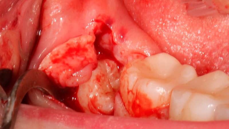 Removal of a wise tooth