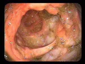 Doença de Crohn em criança