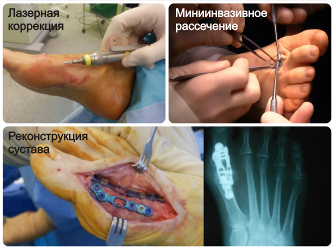 Arten von chirurgischem Eingriff in den Knochen auf den Beinen